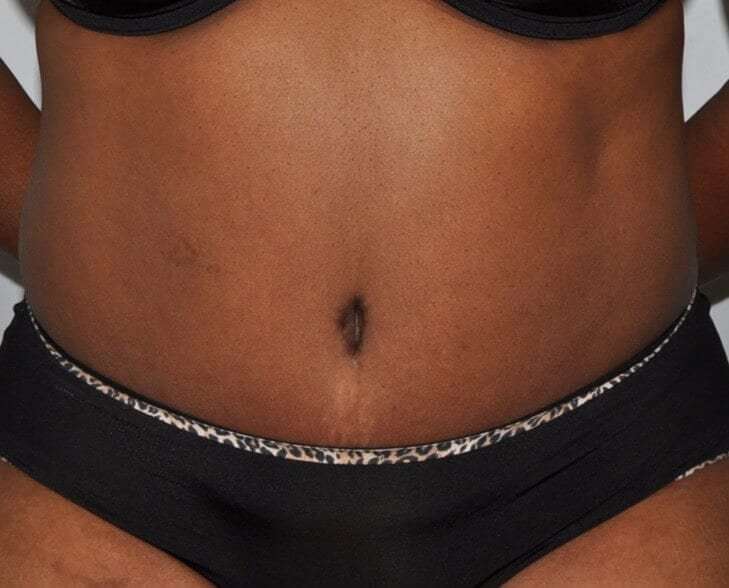 Abdominoplasty (Tummy Tuck) Before & After Patient #913