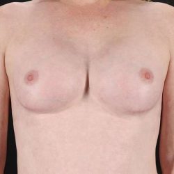 Male To Female Breast Before & After Patient #3911