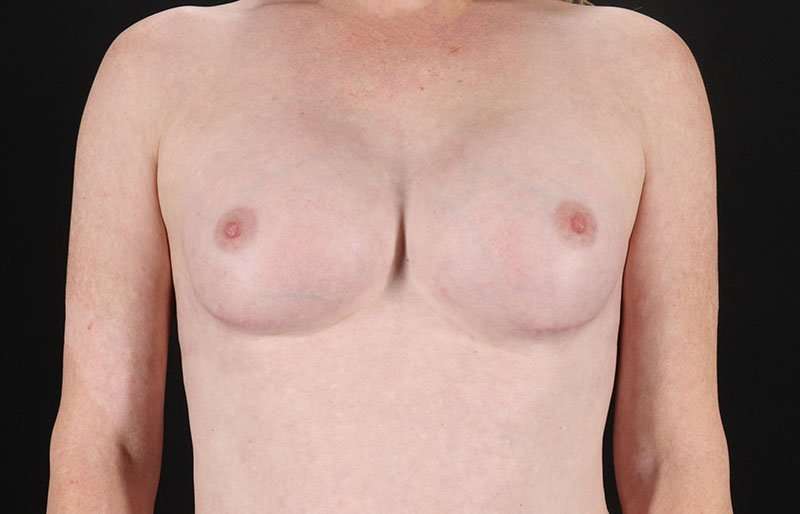 Male To Female Breast Before & After Patient #3911