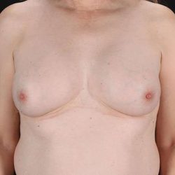 Male To Female Breast Before & After Patient #3922