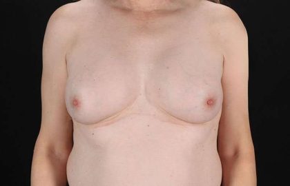 Male To Female Breast Before & After Patient #3922