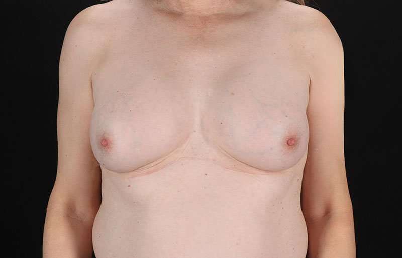 Male To Female Breast Before & After Patient #3922