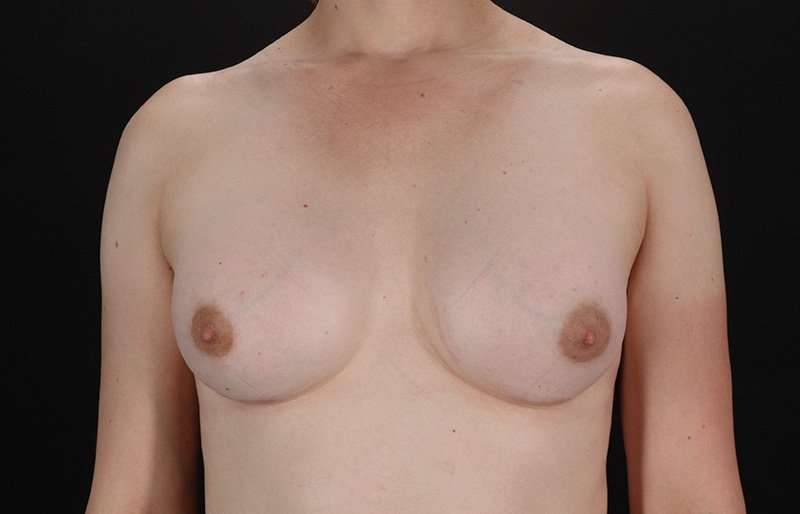 Male To Female Breast Before & After Patient #3933