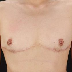 Female To Male Breast Before & After Patient #3944