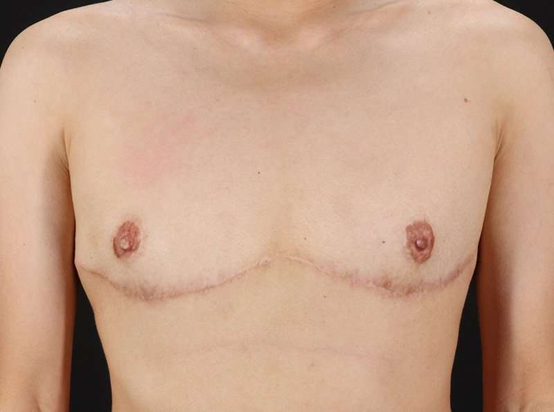 Female To Male Breast Before & After Patient #3944