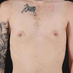 Female To Male Breast Before & After Patient #3955