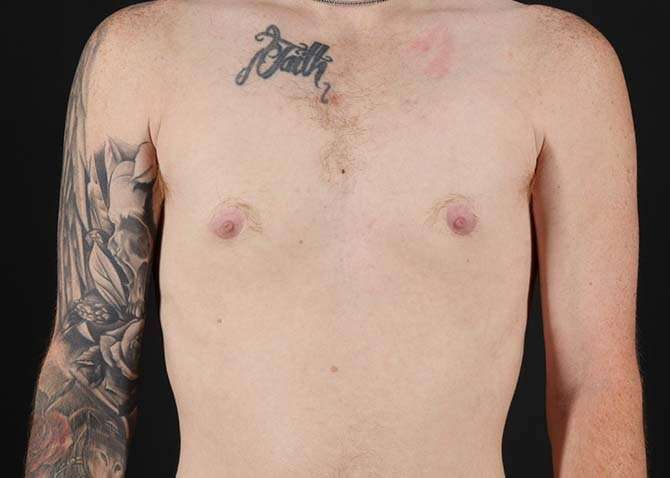 Female To Male Breast Before & After Patient #3955
