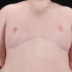 Female To Male Breast Before & After Patient #3966