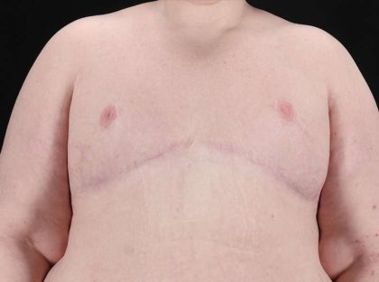 Female To Male Breast Before & After Patient #3966