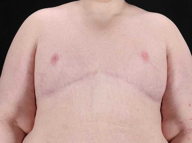Female To Male Breast Before & After Patient #3966