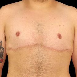 Female To Male Breast Before & After Patient #3977