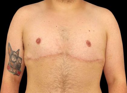Female To Male Breast Before & After Patient #3977