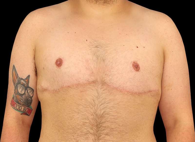 Female To Male Breast Before & After Patient #3977