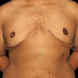 Female To Male Breast Before & After Patient #3984