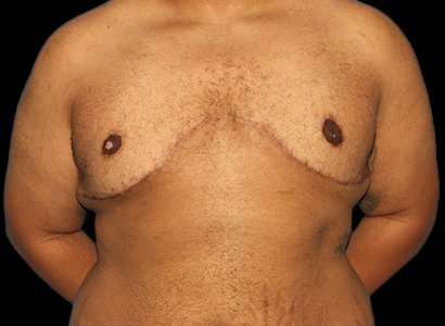 Female To Male Breast Before & After Patient #3984