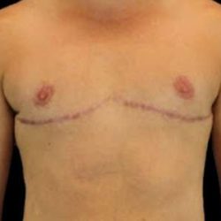 Female To Male Breast Before & After Patient #3991