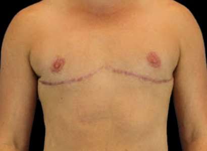 Female To Male Breast Before & After Patient #3991