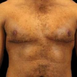 Female To Male Breast Before & After Patient #3998