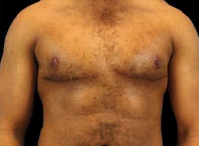 Female To Male Breast Before & After Patient #3998