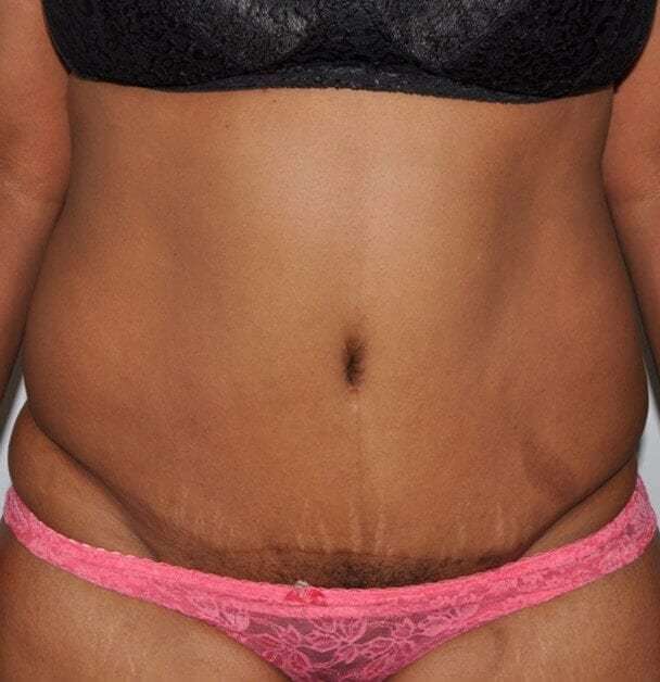 Abdominoplasty (Tummy Tuck) Before & After Patient #920