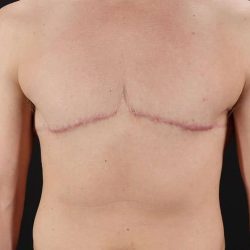 Female To Male Breast Before & After Patient #4009