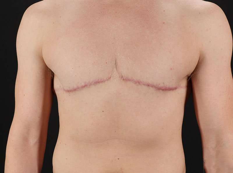Female To Male Breast Before & After Patient #4009