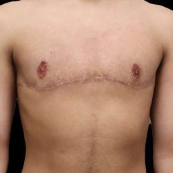 Female To Male Breast Before & After Patient #4020
