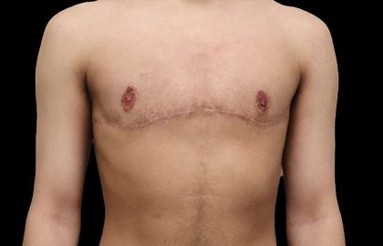 Female To Male Breast Before & After Patient #4020