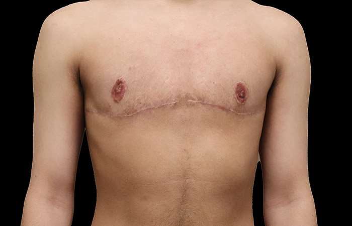 Female To Male Breast Before & After Patient #4020