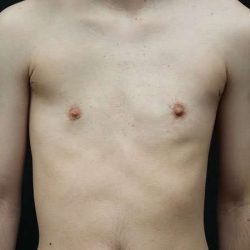 Female To Male Breast Before & After Patient #4031