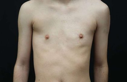 Female To Male Breast Before & After Patient #4031