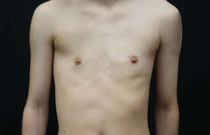 Female To Male Breast Before & After Patient #4031