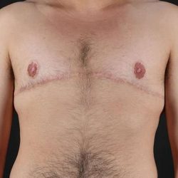 Female To Male Breast Before & After Patient #4042