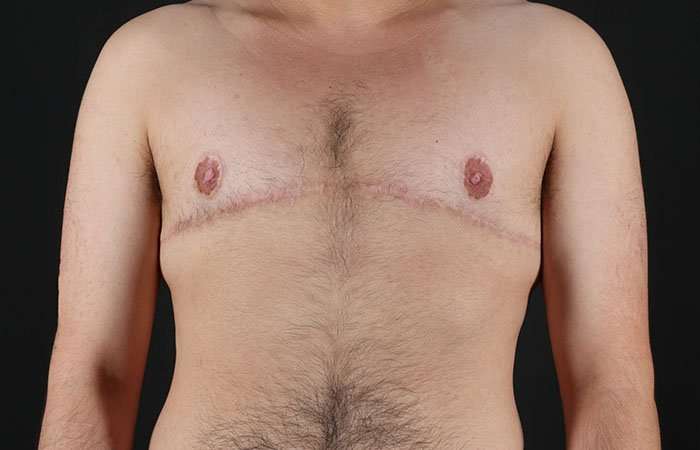 Female To Male Breast Before & After Patient #4042