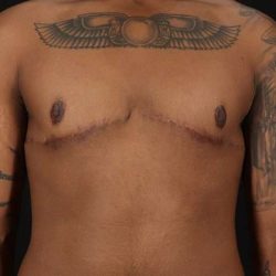 Female To Male Breast Before & After Patient #4053