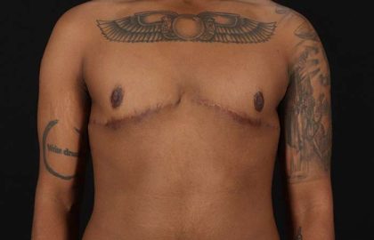 Female To Male Breast Before & After Patient #4053