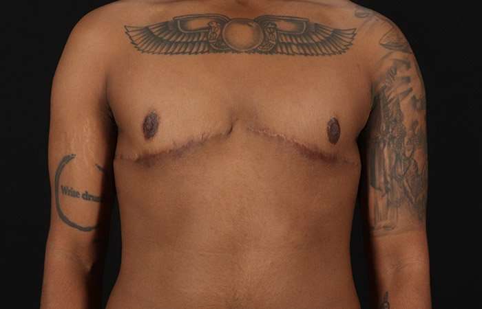 Female To Male Breast Before & After Patient #4053