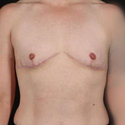 Female To Male Breast Before & After Patient #4064