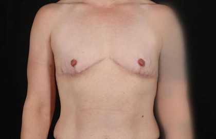 Female To Male Breast Before & After Patient #4064