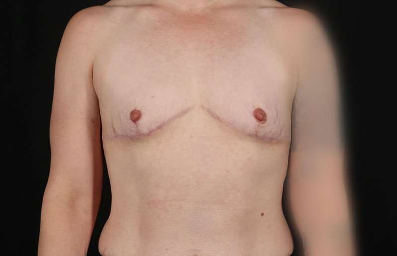 Female To Male Breast Before & After Patient #4064