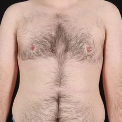 Female To Male Breast Before & After Patient #4075