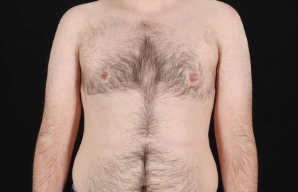 Female To Male Breast Before & After Patient #4075