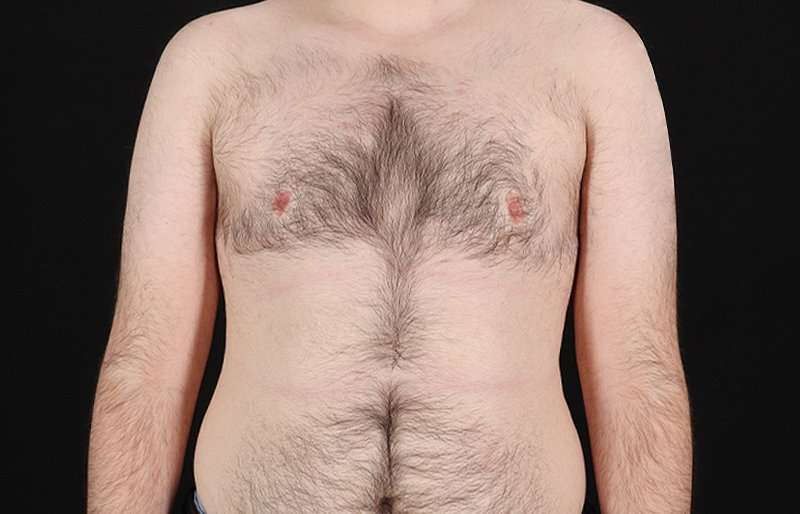 Female To Male Breast Before & After Patient #4075