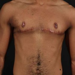 Female To Male Breast Before & After Patient #4086