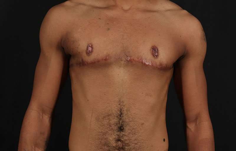 Female To Male Breast Before & After Patient #4086