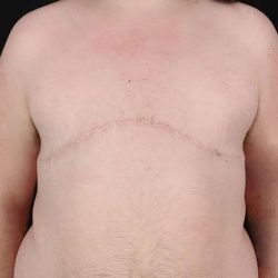 Female To Male Breast Before & After Patient #4097