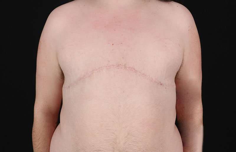 Female To Male Breast Before & After Patient #4097