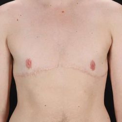 Female To Male Breast Before & After Patient #4108