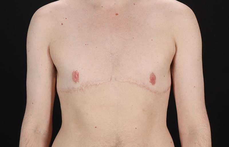 Female To Male Breast Before & After Patient #4108