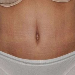 Abdominoplasty (Tummy Tuck) Before & After Patient #928
